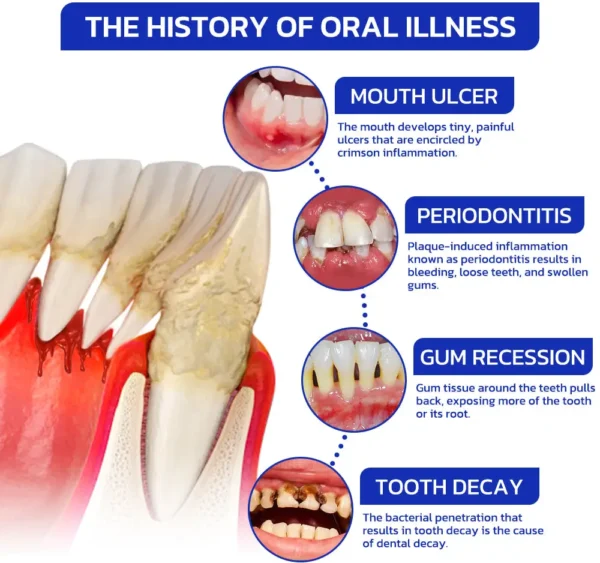 Furzero™ EaseSmile Gums Therapy & Pain Relief Probiotics Bee Venom Chicles