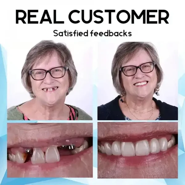 Seurico™ Premium Custom Silicone Denture Set